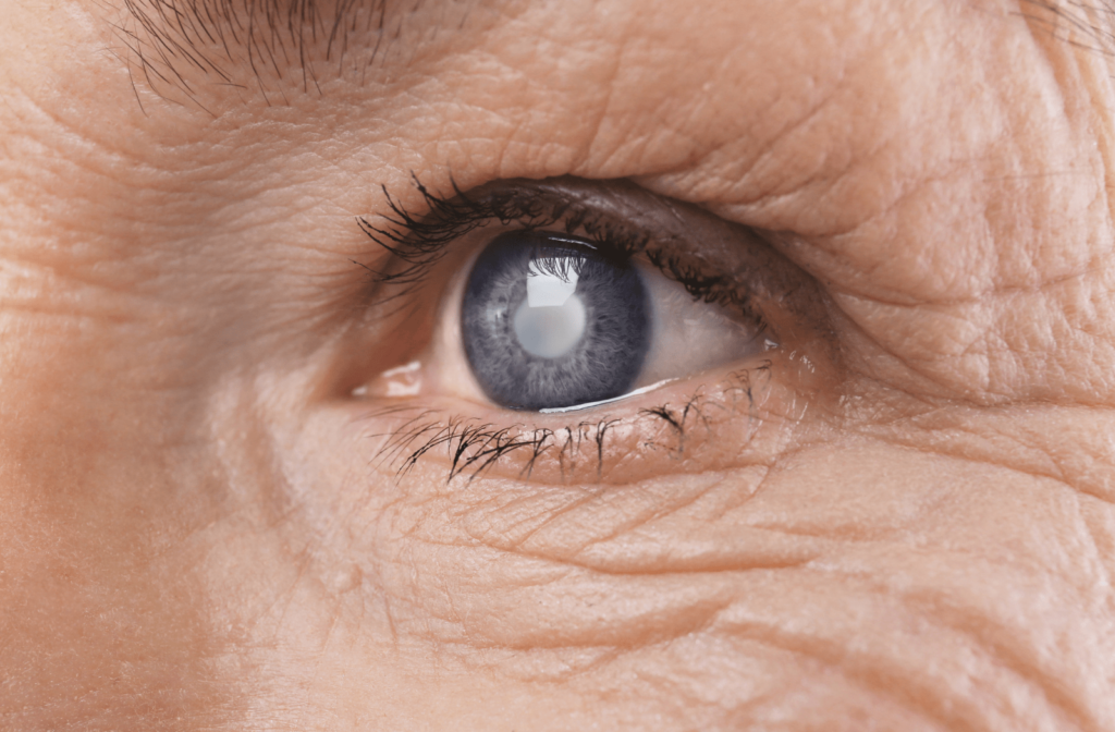 A close up image of a woman's eye with a cataract