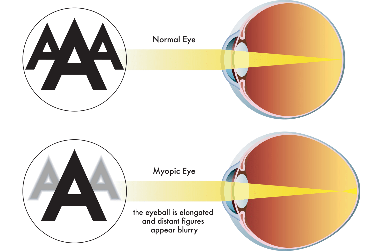 A diagram showing how the light shines in a normal eye, compared to a myopic eye. People with myopia cannot see distant objects very well because the eyeball is elongated
