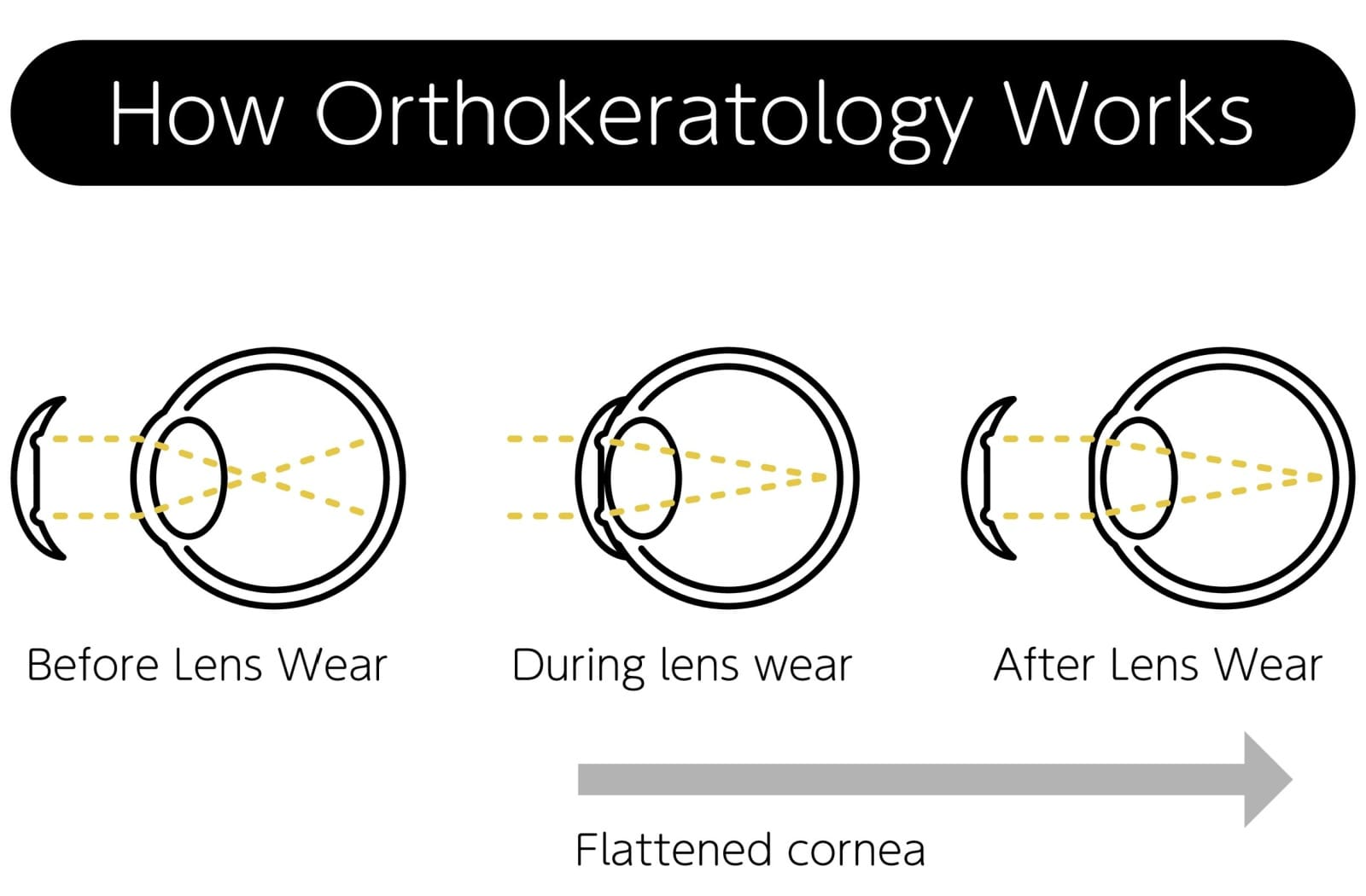 A graphic describing how ortho-k lenses can flatten the cornea when wearing it and afterwards