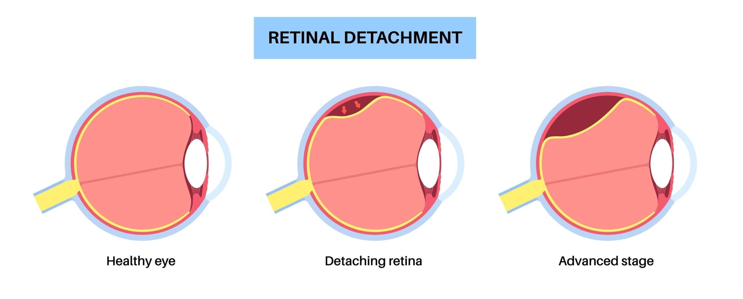 Diagram showing three stages of retinal detachment: a healthy eye, an eye with the retina beginning to detach, and an eye with advanced retinal detachment.