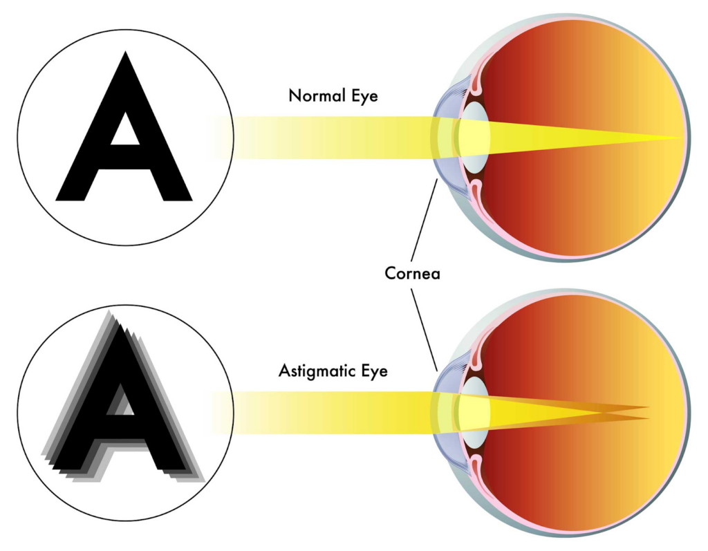 A driver’s perspective from inside a car at night, showing streaked and blurred traffic lights characteristic of astigmatism.